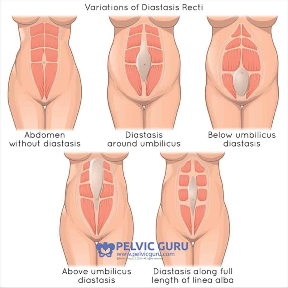 Diastasis Recti (Part 1)