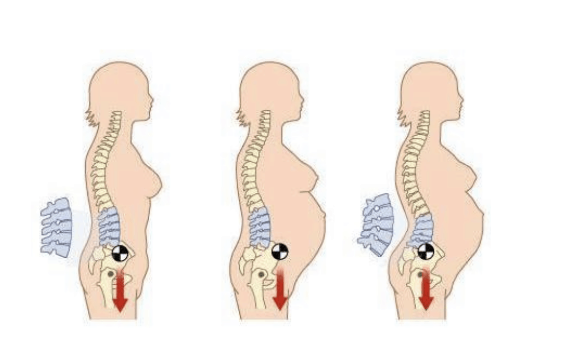 Pregnancy Related Back Pain & Posture