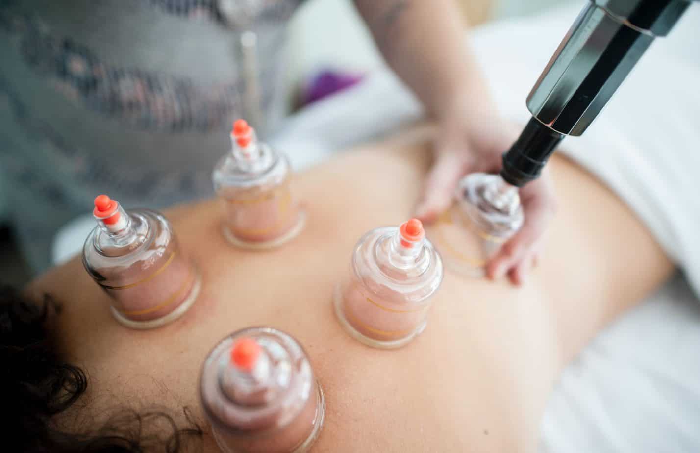 Cupping: What exactly is it?